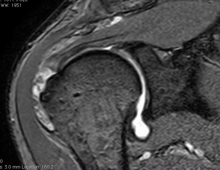 Az MRI felvételen a m. supraspinatus ín áthatoló szakadása látható.